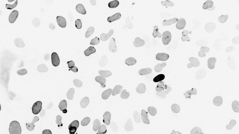 Field of cardiac cell nuclei expressing a library of LMNA mutants, with varied staining intensity and nuclear shape.